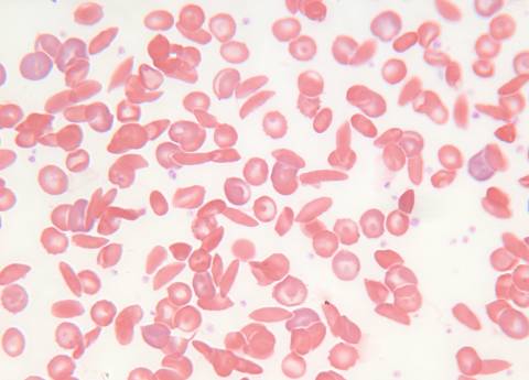 Sickle cell disease seen under the microscope, with different sized red blood cells